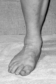 Pronated Ankle