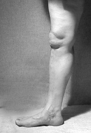 Hyperextended Knee